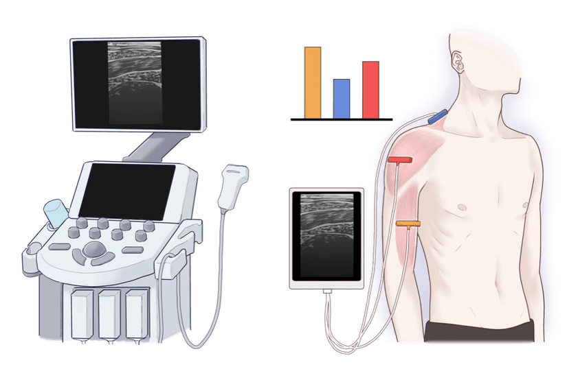 SONoALS Ultrasound Technology